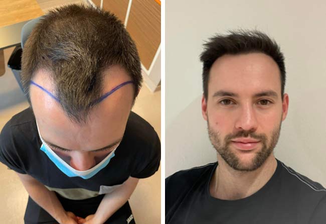 Picture Before after sapphire hair transplantation 2700 grafts Alexander Volwerk