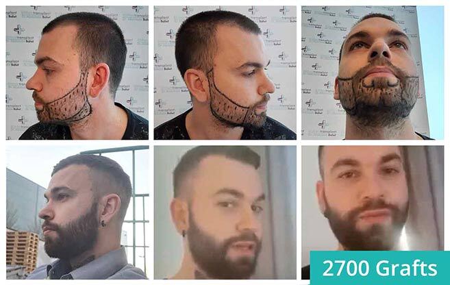 Thumbnail picture before and after the beard transplant of Nico Müller