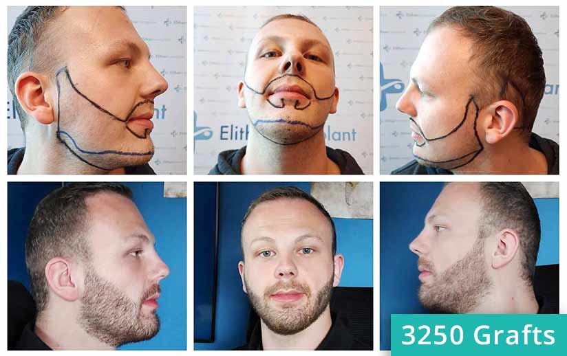 Thumbnail picture before and after the beard transplant of Sascha Lockemann