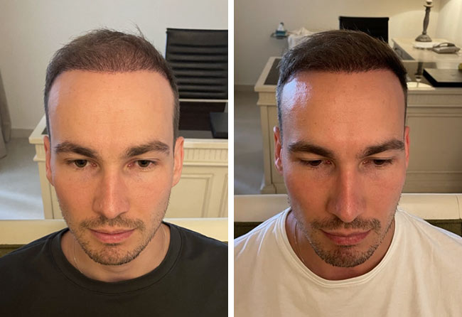 Picture before after dhi hair transplantation 4700 grafts Marcel Ploch after 6 months