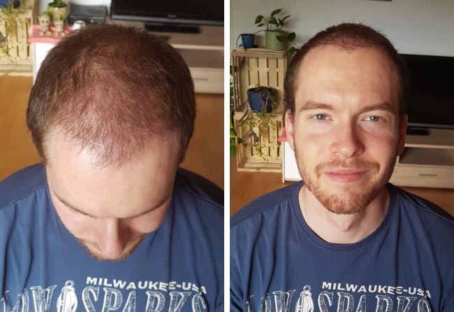 Picture before after dhi hair transplantation 3500 grafts Lukas jaeger 2 months