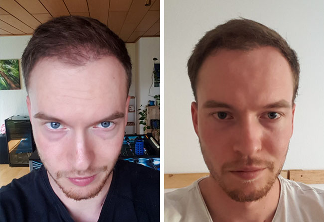 Picture before after dhi hair transplantation 3500 grafts Lukas jaeger 4 months