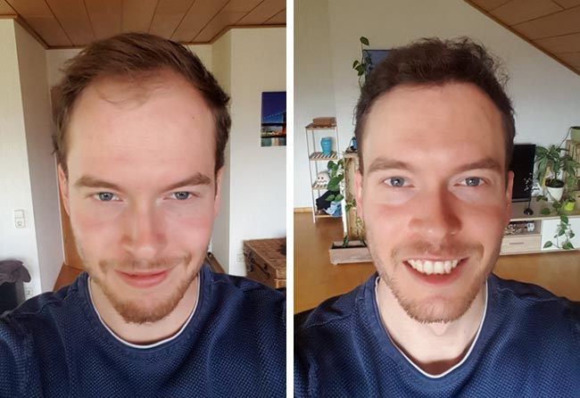 Picture before after dhi hair transplantation 3500 grafts Lukas jaeger