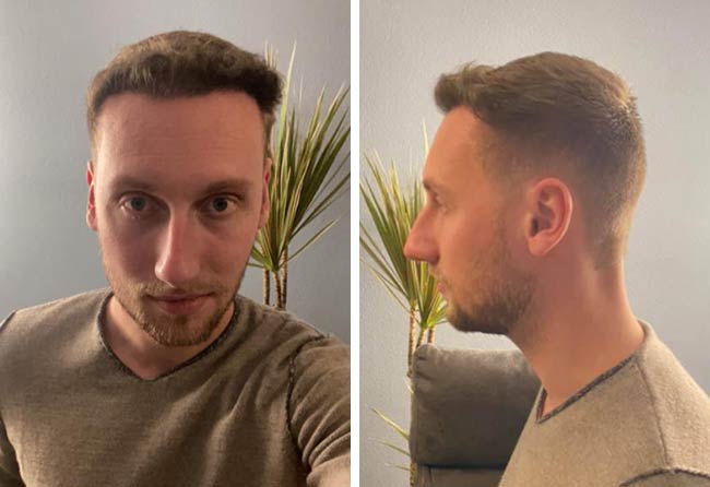 Picture before after dhi hair transplantation 3950 grafts Oliver Dietrich after 6 months