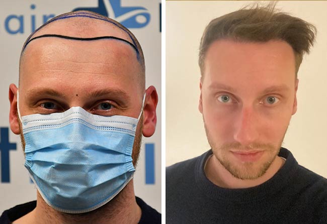 Picture before after dhi hair transplantation 3950 grafts Oliver Dietrich