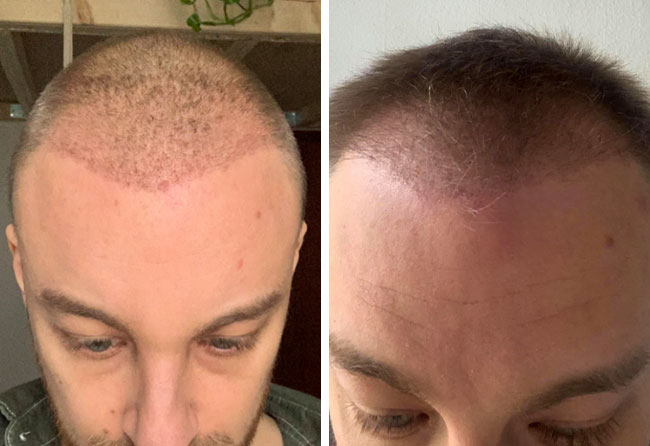 Picture before after dhi hair transplantation 4200 grafts Marius Schmiddi after 4 months