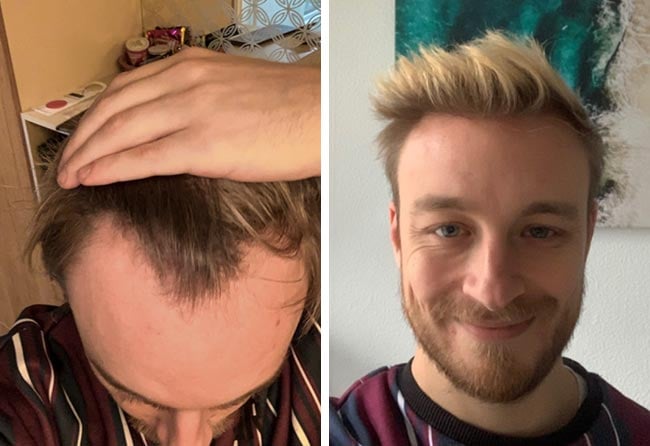 Picture before after dhi hair transplantation 4200 grafts Marius Schmiddi