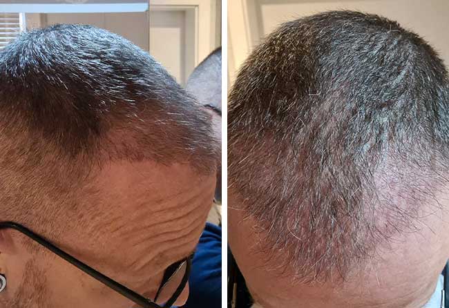 Picture before after dhi hair transplantation 4500 grafts Steffen Kraeuter after 5 months