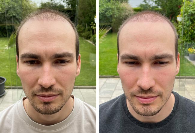 Picture before after dhi hair transplantation 4700 grafts Marcel Ploch after 2 months