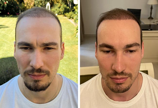 Picture before after dhi hair transplantation 4700 grafts Marcel Ploch after 4 months