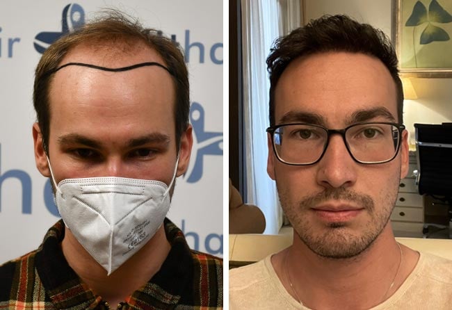 Picture before after dhi hair transplantation 4700 grafts Marcel Ploch
