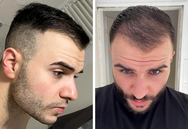 Picture before after dhi hair transplantation 4700 grafts Okan Yueksel after 3 months