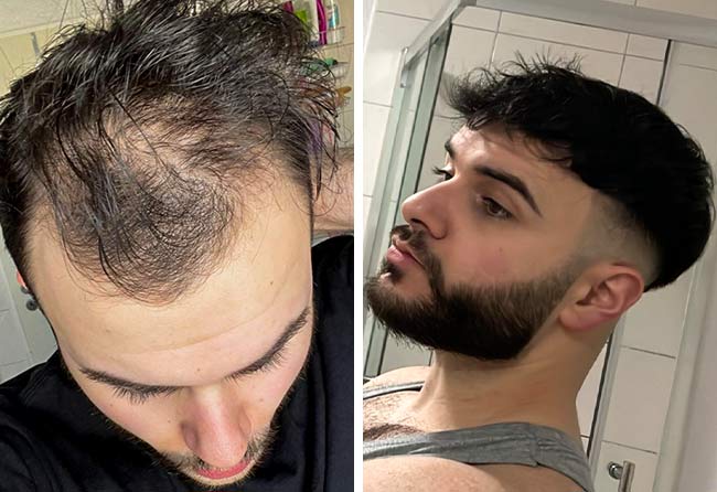 Picture before after dhi hair transplantation 4700 grafts Okan Yueksel