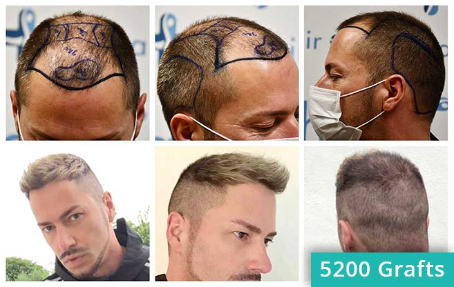 Thumbnail picture of the before and after results of the hair transplant of Andre O