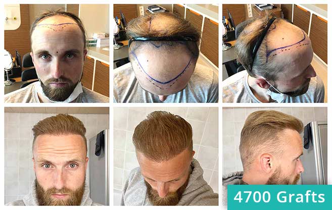 Methods of Hair Transplant FUT FUE and DHI