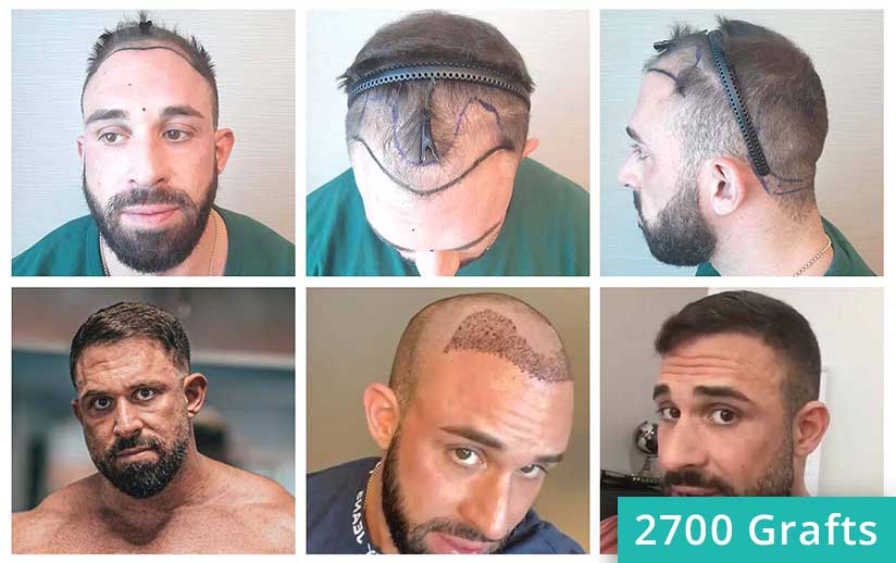 Thumbnail picture before and after the percutaneous hair transplant of Kevin Wolter