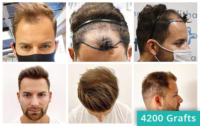 Thumbnail pictures before and after the hair transplant of Marcel Oliva