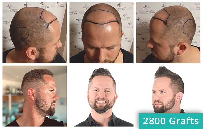 Different Types of Hair Transplant Treatment