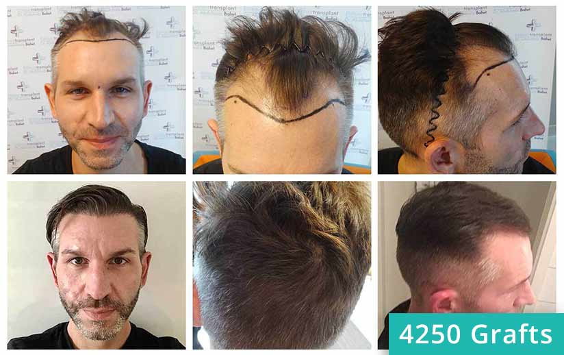Thumbnail picture before and after the sapphire hair transplant of Thomas Schreier
