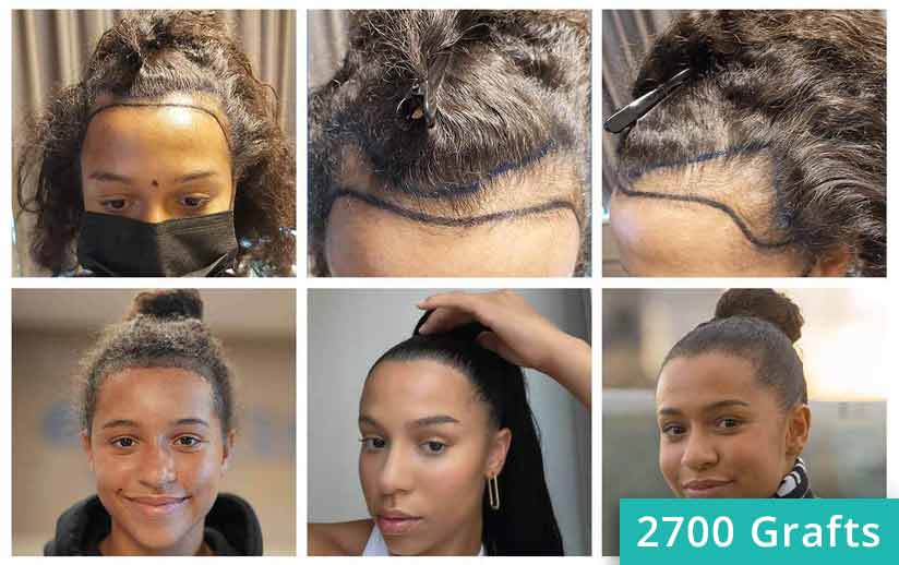 Thumbnail picture before and after the hair transplant for woman of Melissa Zerhau