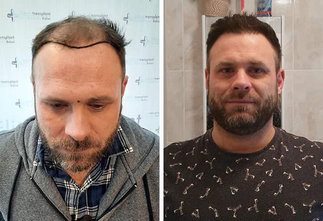 Picture before after percutaneous hair transplantation 3700 grafts Michael Woulfe
