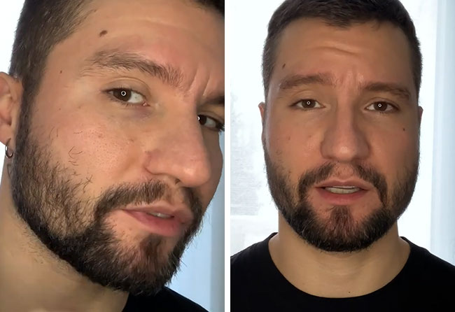 Picture before after sapphire beard transplantation 3500 grafts Dominik Schmitz after 3 months
