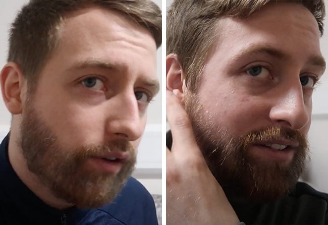 Picture before after sapphire beard transplantation 4200 grafts Jay Jones after 4 months