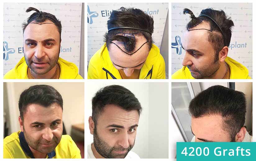 Thumbnail picture before and after sapphire hair transplant of Murat Kizilkaya