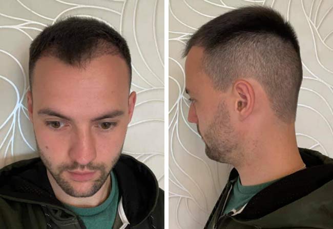 Picture Before after sapphire hair transplantation 2700 grafts Alexander Volwerk after 2 months