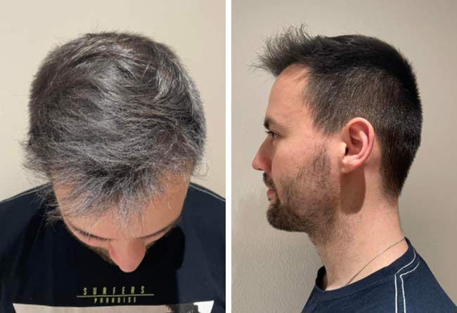 Picture Before after sapphire hair transplantation 2700 grafts Alexander Volwerk after 5 months