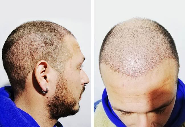 Picture before after sapphire hair transplantation 4200 grafts Jorge Diaz after 1 month