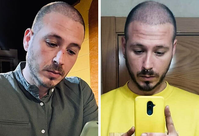 Picture before after sapphire hair transplantation 4200 grafts Jorge Diaz after 3 months