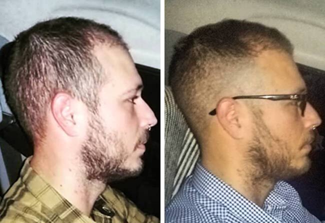 Picture before after sapphire hair transplantation 4200 grafts Jorge Diaz after 5 months