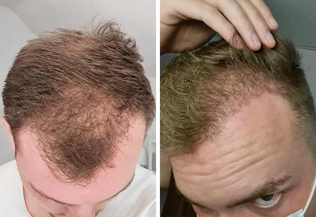 Picture before after sapphire hair transplantation 4200 grafts Marc Stehr after 4 months