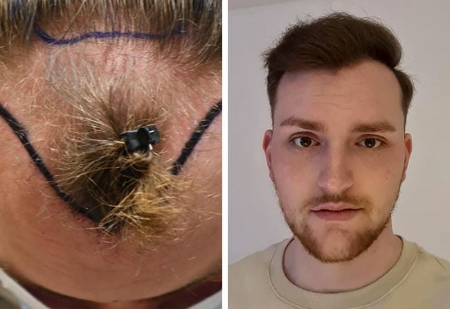 Picture before after sapphire hair transplantation 4200 grafts Marc Stehr