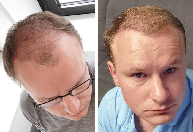Picture before after sapphire hair transplantation 4200 grafts Sergej Weresomski after 6 months
