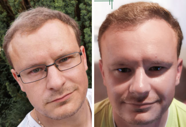 Picture before after sapphire hair transplantation 4200 grafts Sergej Weresomski after 8 months