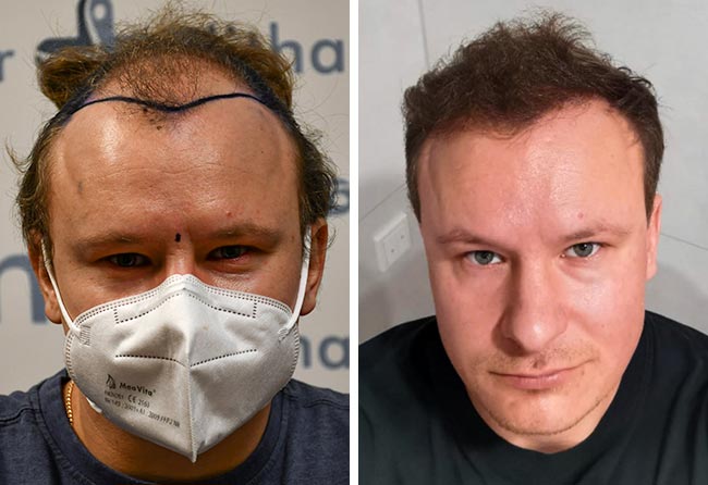 Picture before after sapphire hair transplantation 4200 grafts Sergej Weresomski