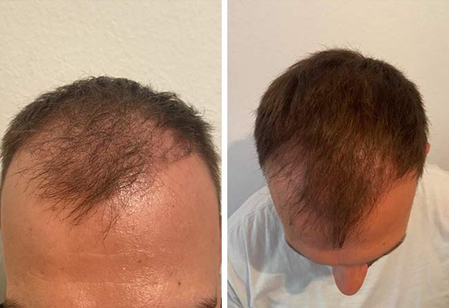Picture before after sapphire hair transplantation 4500 grafts Sefket Ahmetovic after 3 months