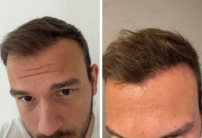 Picture before after sapphire hair transplantation 4500 grafts Sefket Ahmetovic after 6 months