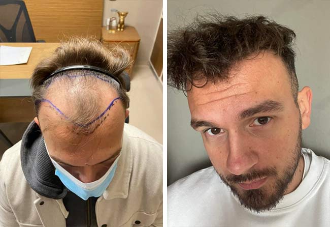 Picture before after sapphire hair transplantation 4500 grafts Sefket Ahmetovic
