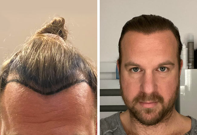 Matthias F: before after pictures - 2700 Grafts | Elithair