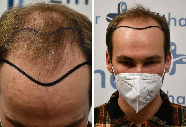 Picture before dhi hair transplantation 4700 grafts Marcel Ploch