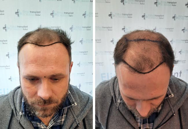 Picture before percutaneous hair transplantation 3700 grafts Michael Woulfe