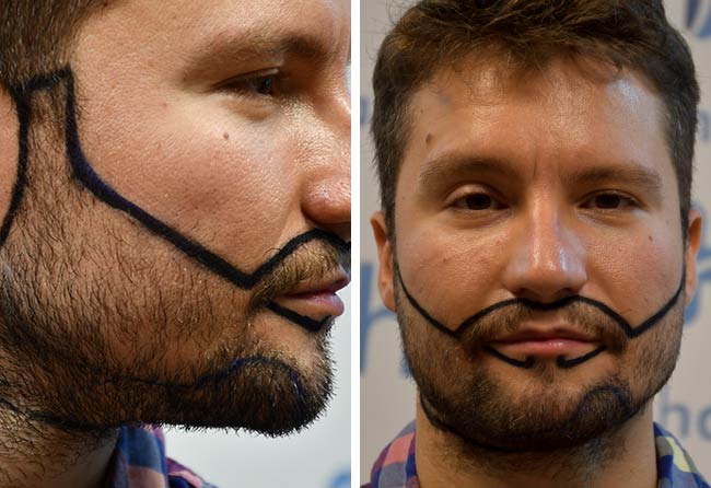 Picture before sapphire beard transplantation 3500 grafts Dominik Schmitz