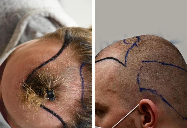 Picture before sapphire hair transplantation 4200 grafts Marc Stehr