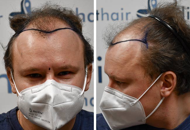 Picture before sapphire hair transplantation 4200 grafts Sergej Weresomski