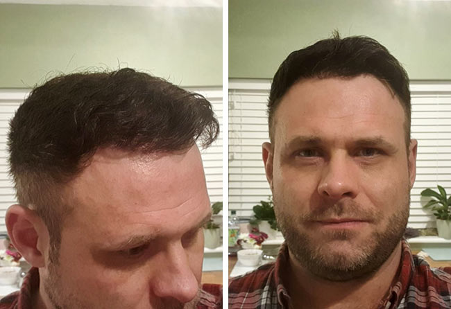 Picture of Michael W, an Elithair patient, showing the result of his hair transplant with 3700 grafts