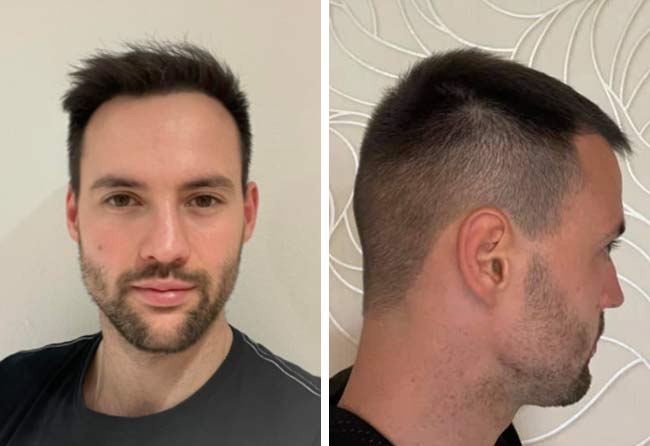 Picture Before after sapphire hair transplantation 2700 grafts Alexander Volwerk result