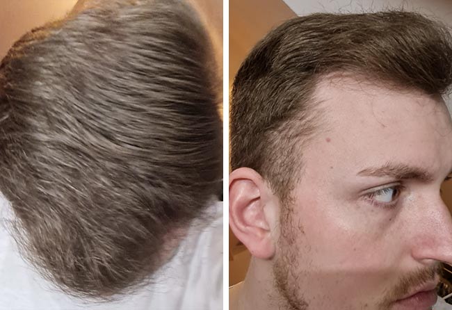 Picture results sapphire hair transplantation 4200 grafts Marc Stehr
